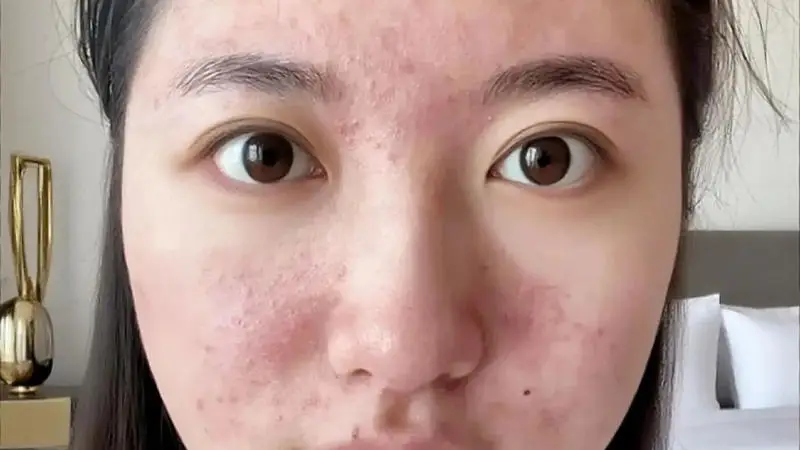 原创15岁女儿看皮肤却被开避孕药，妈妈怒气冲冲问为什么？医生的一番解释让妈妈羞惭不已，连连道谢