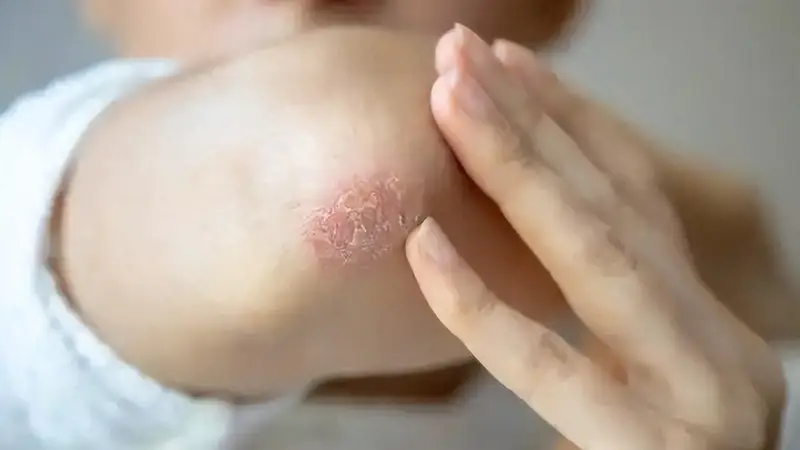 湿疹不敢吃鸡蛋？医生告诫：不想病情反复，这4种食物要忌口