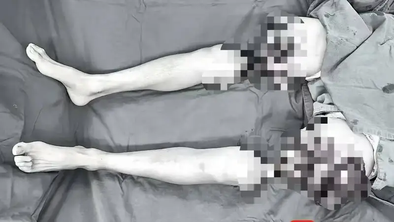 男子双大腿被绞断完全分离，经手术重新“接”回
