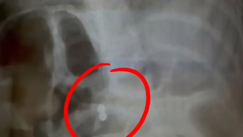 三岁男童误吞磁力珠,奶奶与医生意见分歧引关注