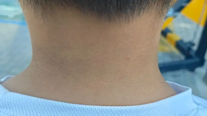 孩子脖子发黑?警惕黑棘皮病,速查内分泌健康